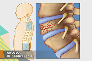 پوکی استخوان اصلی ترین عامل شکستگی های ستون فقرات