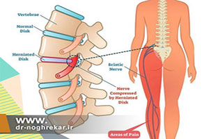 تنگی کانال نخاعی چگونه درمان می شود؟