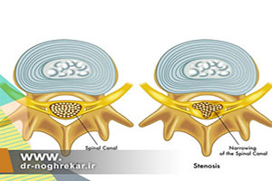تفاوت بین آرتروز کمر و تنگی کانال نخاعی
