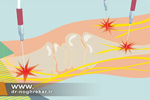 عصب کشی با امواج رادیوفرکوئنسی روشی برای درمان درد