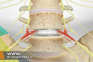 درمان درد ستون فقرات با جراحی های بسته دیسک