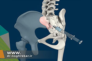 تزریق در مفصل ساکروایلیاک برای درمان درد باسن