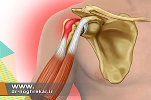 ورزش های مفید برای التهاب تاندون دو سر بازو