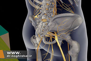 عصب سیاتیک چیست و علت درد آن کدام است؟