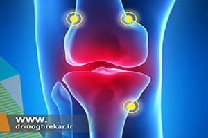 استفاده از امواج رادیویی آر اف برای حذف درد در آرتریت