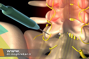 آیا استفاده از امواج فرکانس رادیویی دردناک است؟