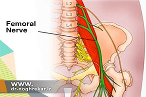 درمان درد و سوزش کنار ران با بلوک عصبی لترال فمورال