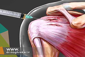 درمان غیر جراحی روتاتور کاف با پلاسمای غنی از پلاکت