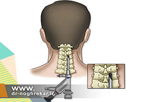 جراحی آندوسکوپی ستون فقرات کمری و گردنی