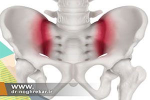 درمان درد مفصل ساکروایلیاک (مفصل خاجی خاصره) با ورزش