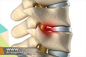 آموزش تصویری ورزشهای مناسب بیرون زدگی دیسک کمر