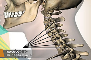 درد مفصل فاست گردن با چه ورزشهایی بهبود می یابد؟