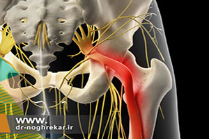 درد عصب سیاتیک و درمان غیرجراحی سیاتیک