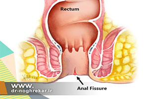علت و درمان اسپاسم و درد ناگهانی مقعد