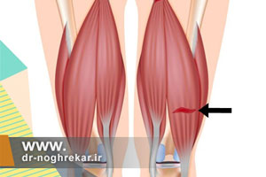 درمان آسیب و پارگی عضله همسترینگ