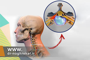 روشهای درمانی بدون جراحی دیسکوپاتی گردن