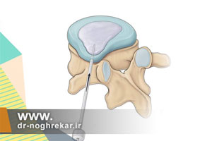 هیدرودیسککتومی، جدیدترین روش درمان دیسک