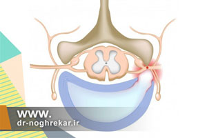 چه دارو هایی می توانند چسبندگی کانال نخاعی را برطرف کنند؟