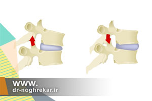 علت خمیدگی و تغییرات غیرمتعارف مفاصل کمر با افزایش سن