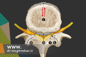 تفاوت تنگی کانال و چسبندگی کانال نخاعی چیست؟