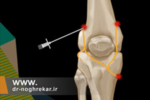 درمان آرتروز شدید با نورولیز اعصاب ژنیکولار زانو