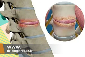 عفونت ستون فقرات؛ علت علائم و روشهای تشخیص