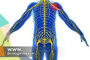 پلی نوریت (Polyneuritis) یا نوروپاتی محیطی چیست؟