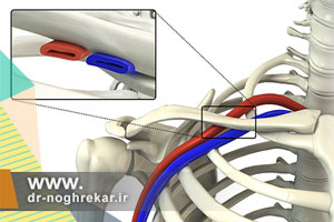 سندروم خروجی قفسه سینه (TOS) چیست و چگونه درمان می شود؟
