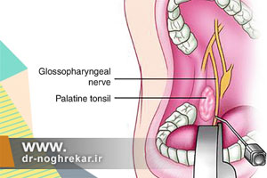 نورالژی گلوفارنکس (GPN) یا عصب زبانی حلقی چیست؟