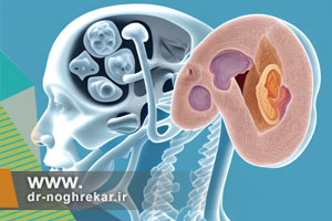 منیر چه نوع بیماری است و چگونه درمان می شود؟