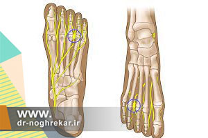 بیماری مورتون نوروما چه علائمی دارد و چگونه درمان میشود؟