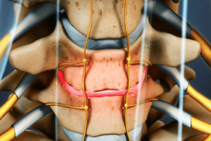 علائم دیسک گردن چیست و چطور می توان از آنها پیشگیری کرد؟