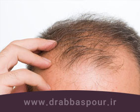 علل ریزش مو ارثی در مردان