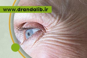 ایا چروک پنجه کلاغی دور چشم قابل درمان است؟