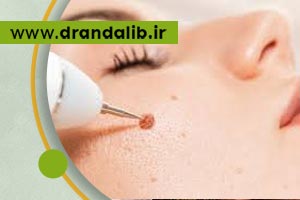 رفع خال های گوشتی به روش کرایوتراپی یا سرما درمانی