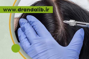 اثرات تزریق هیر فیلر در رفع ریزش مو