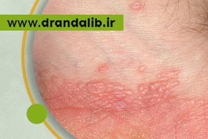 لیکن پلان چیست؟ علائم، علت و روش های درمان