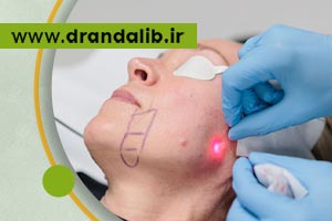 کاربرد اندولیفت چیست؟ | مراحل انجام، مراقبت ها و هزینه اندولیفت