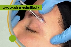 تزریق بوتاکس ابرو برای بالا بردن ابرو در اصفهان - دکتر عندلیب