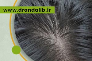 علت ریزش مو استرسی چیست؟ | درمان ریزش مو ناشی از استرس