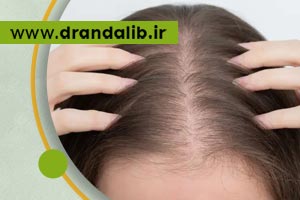 از کجا بفهمیم ریزش مو هورمونی است؟ | درمان ریزش هورمونی مو