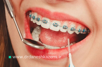 نخ دندان مخصوص ارتودنسی؛ تمیز کردن دندان های ارتودنسی شده