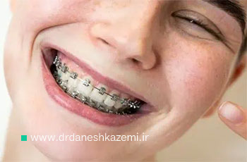 ارتودنسی روی دندان کامپوزیت شده؛ نکات مهم قبل از درمان
