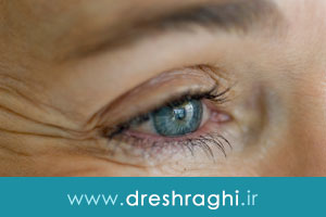 آیا بیماران مبتلا به فشار چشم می توانند جراحی زیبایی پلک انجام دهند؟