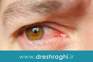انواع عفونتهای چشمی و روشهای درمان آن