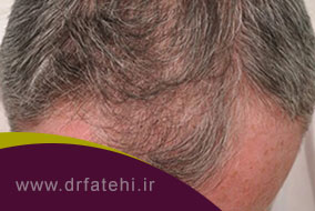 اقدامات لازم بعد از کاشت مو به روش FIT