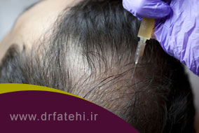 PRP (پی آر پی) مو چیست؟