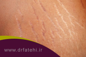 ترک های آزار دهنده پوستی یا استریا چه هستند و چگونه درمان میشوند؟