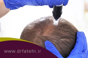 میکرونیدلینگ مو درمانی موثر در قطع ریزش موی سر