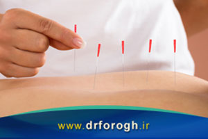 کاربرد سوزن خشک یا درای نیدلینگ (dry needling) در طب فیزیکی